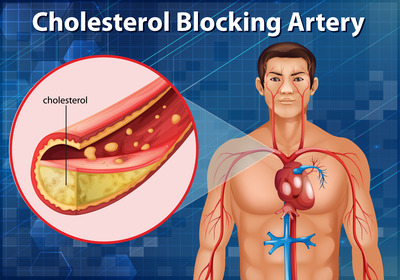 ARTICHOK AND CHOLESTEROL 