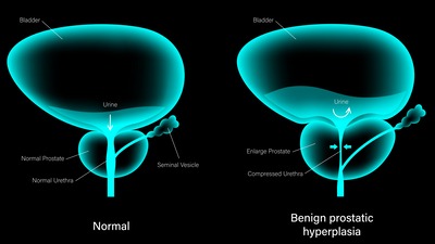 POMERGANATE JUICE PROSTATE